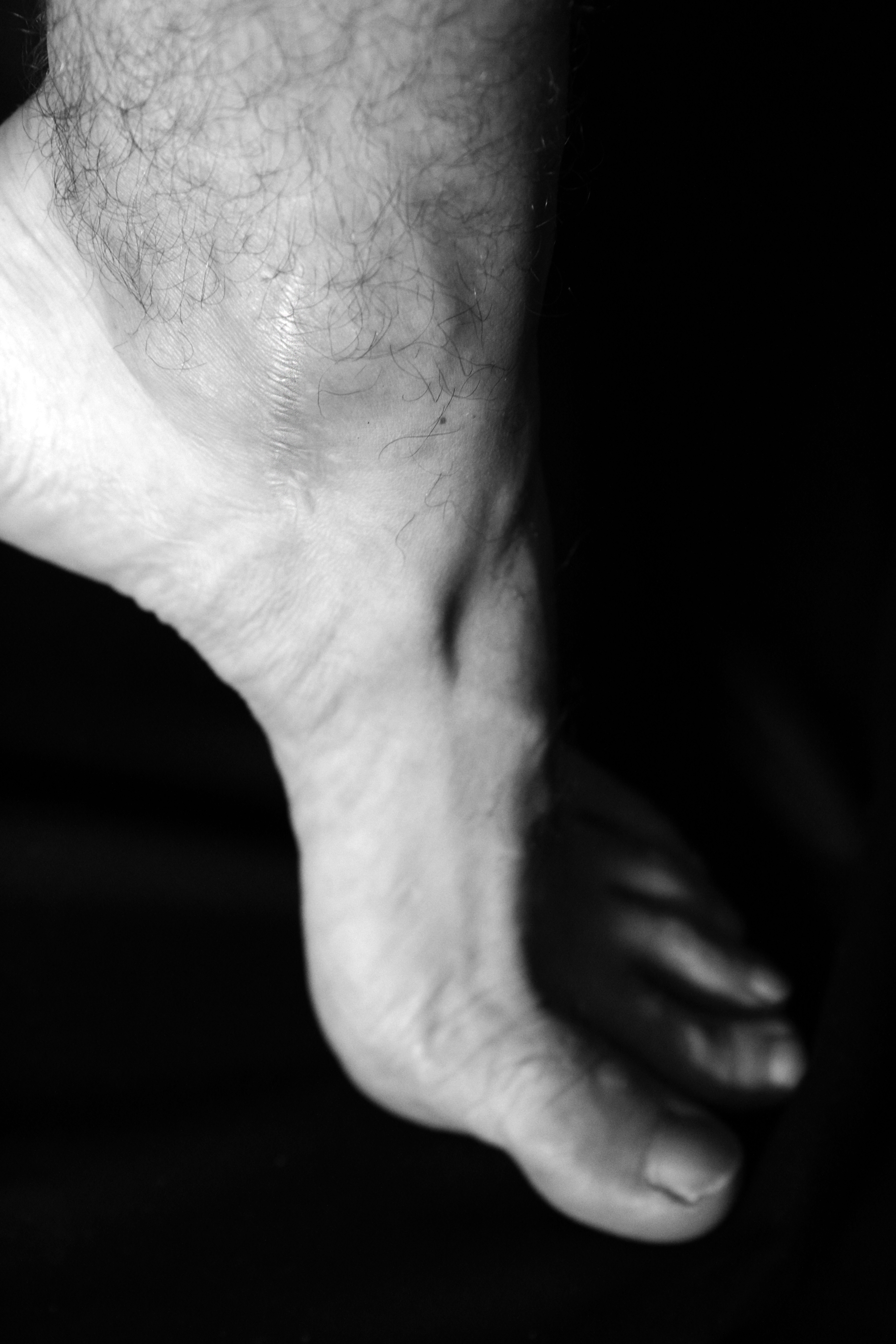 cicatrice piede